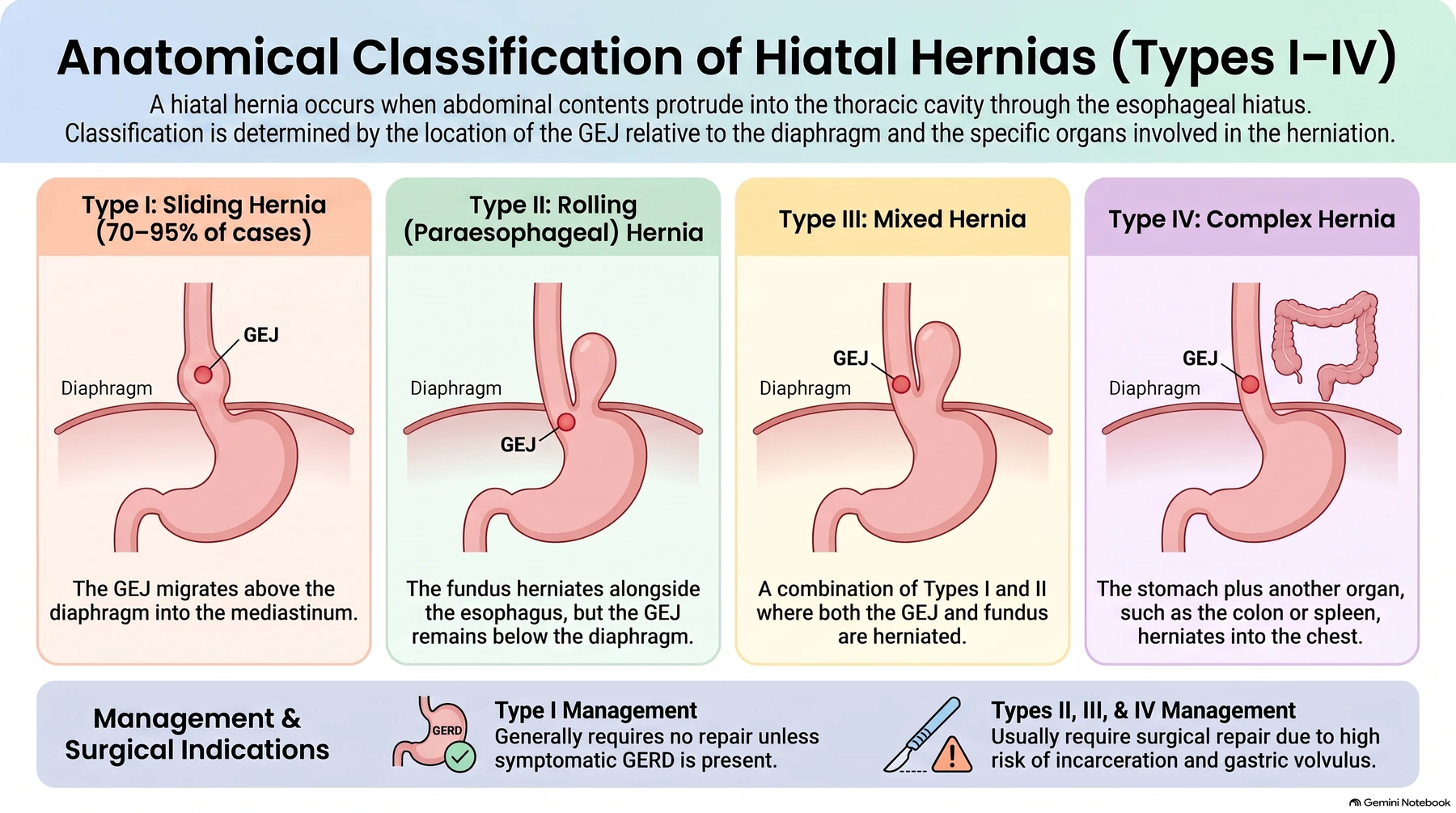 Anatomical classification of hiatal hernia: Type I sliding, GEJ migrating above the diaphragm into the mediastinum, 70–95% of cases; Type II rolling/paraoesophageal, fundus herniating alongside the oesophagus with the GEJ remaining below the diaphragm; Type III mixed, both GEJ and fundus herniated; Type IV complex, stomach plus another organ such as colon or spleen. Type I generally requires no repair unless symptomatic GERD is present; Types II–IV usually require repair given the risk of incarceration and gastric volvulus